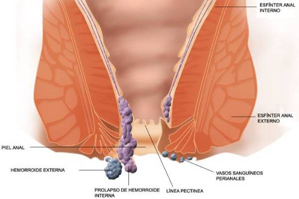 foto en la que se ve un problema de inicio de hemorroides y que todavía puede ser tratado con nuestras sesiones de Hidroterapia de colon en Alajuela, Costa Rica