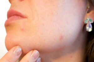 rostro de una chica con acné