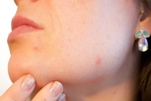 rostro de una chica con acné