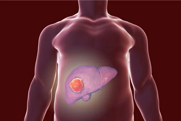 Fotografía en el que se muesta el higado de una persona haciendo referencia a que con la hidroterapia de colon podemos ayuda a muchas personas a mejorar su estado de higado graso
