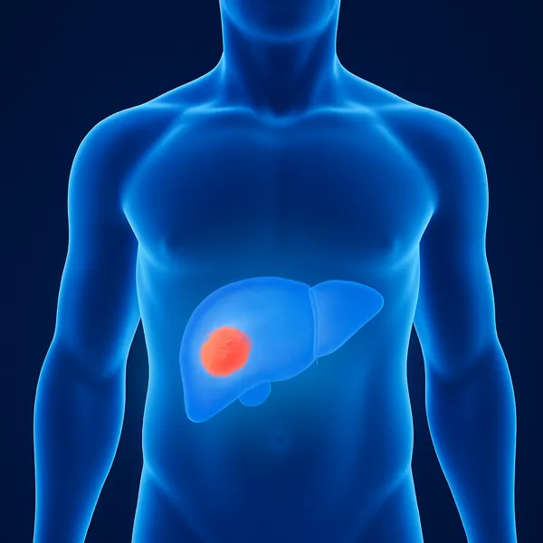 Infografia donde se muestra estado de higado graso